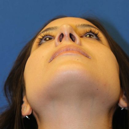 Rhinoplasty Before & After Patient #3573