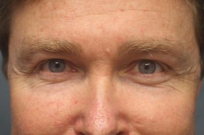 Blepharoplasty Before & After Patient #1774