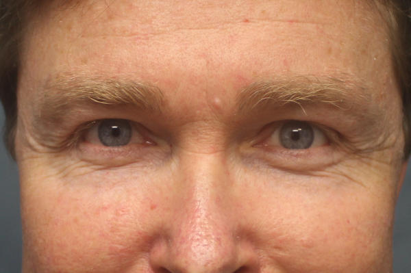 Blepharoplasty Before & After Patient #1774
