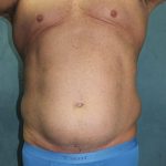 Liposuction Before & After Patient #1808