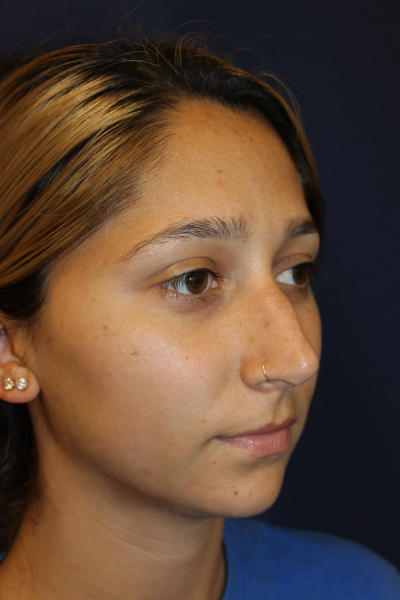 Rhinoplasty Before & After Patient #1671