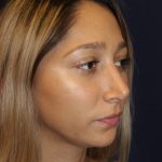 Rhinoplasty Before & After Patient #1671