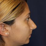 Rhinoplasty Before & After Patient #1671