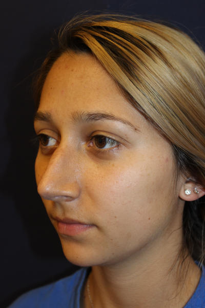 Rhinoplasty Before & After Patient #1671