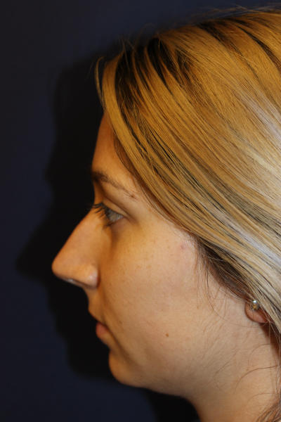 Rhinoplasty Before & After Patient #1671