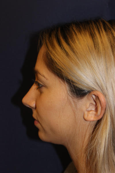 Rhinoplasty Before & After Patient #1671