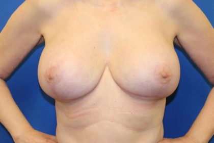 Breast Augmentation Before & After Patient #3439