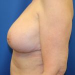 Breast Augmentation Before & After Patient #3439