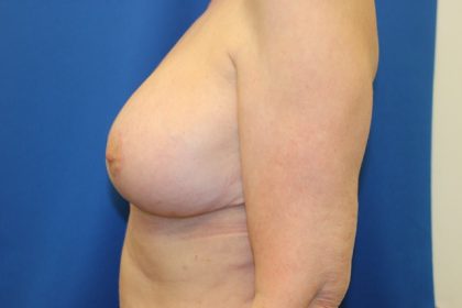 Breast Augmentation Before & After Patient #3439