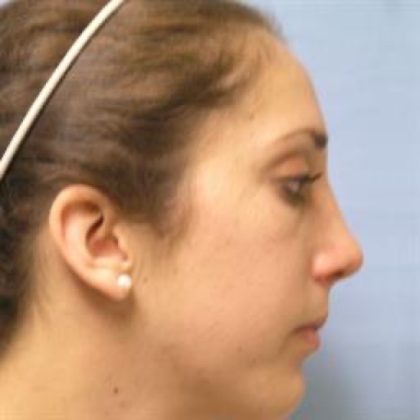Chin Augmentation Before & After Patient #2689