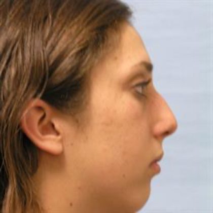 Chin Augmentation Before & After Patient #2689