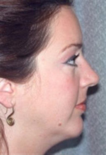 Chin Augmentation Before & After Patient #2688