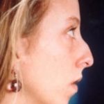 Rhinoplasty Before & After Patient #2666