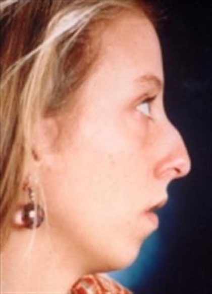 Rhinoplasty Before & After Patient #2666