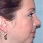 Chin Augmentation Before & After Patient #2688
