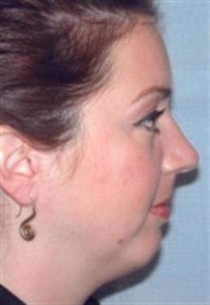 Chin Augmentation Before & After Patient #2686
