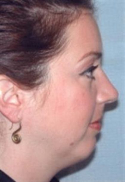 Chin Augmentation Before & After Patient #2688