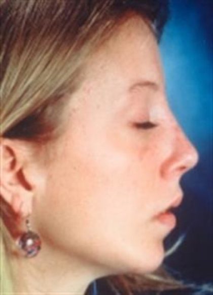 Rhinoplasty Before & After Patient #2666