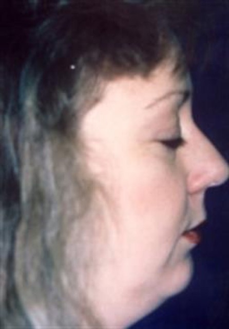 Chin Augmentation Before & After Patient #2669