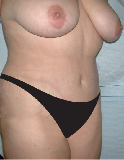 Tummy Tuck Before & After Patient #2819