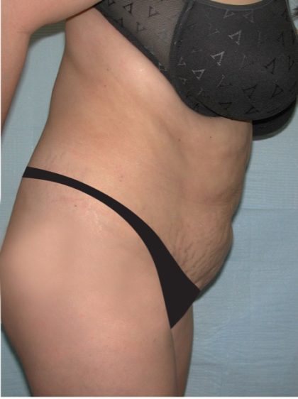 Tummy Tuck Before & After Patient #2819