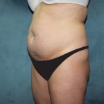 Tummy Tuck Before & After Patient #2819