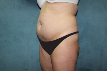 Tummy Tuck Before & After Patient #2819