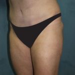 Tummy Tuck Before & After Patient #2819