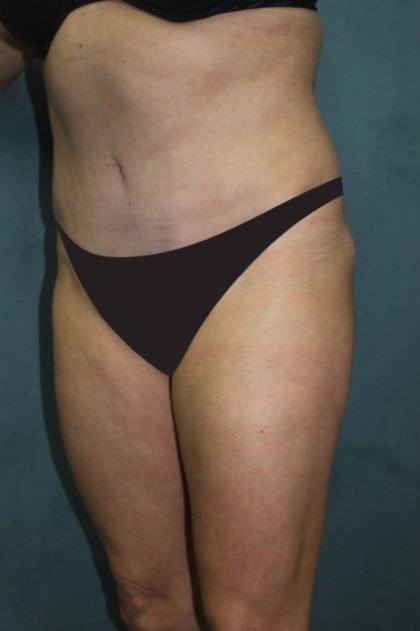 Tummy Tuck Before & After Patient #2819