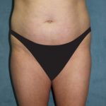 Tummy Tuck Before & After Patient #2819