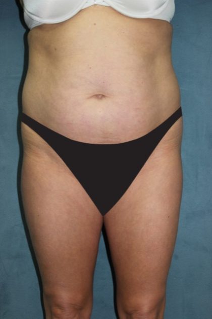 Tummy Tuck Before & After Patient #2819