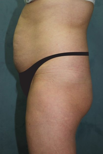 Tummy Tuck Before & After Patient #2819