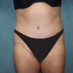 Tummy Tuck Before & After Patient #2819