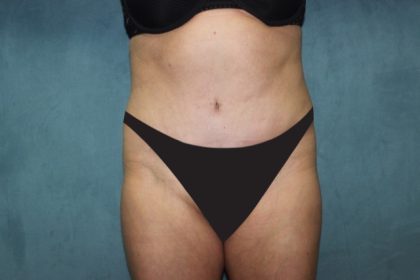 Tummy Tuck Before & After Patient #2819