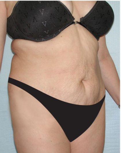 Tummy Tuck Before & After Patient #2819