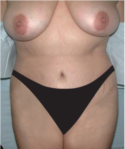 Tummy Tuck Before & After Patient #2819