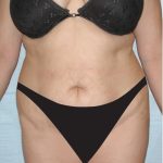 Tummy Tuck Before & After Patient #2819