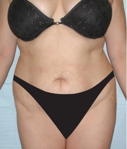 Tummy Tuck Before & After Patient #2819