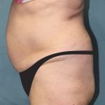 Tummy Tuck Before & After Patient #2865