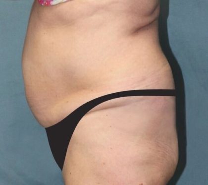 Tummy Tuck Before & After Patient #2865