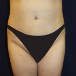 Tummy Tuck Before & After Patient #2885