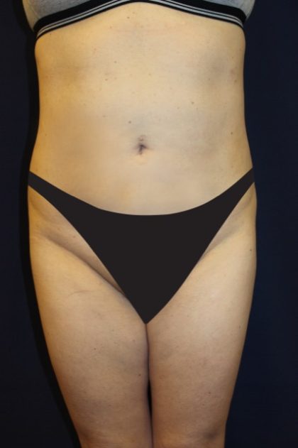 Tummy Tuck Before & After Patient #2885