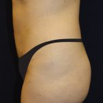 Tummy Tuck Before & After Patient #2885