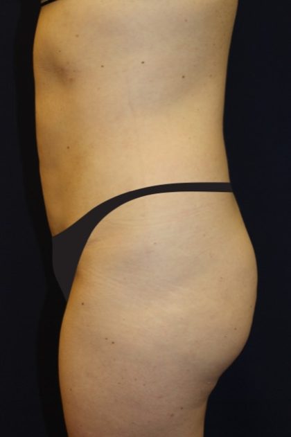 Tummy Tuck Before & After Patient #2885