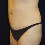 Tummy Tuck Before & After Patient #2885