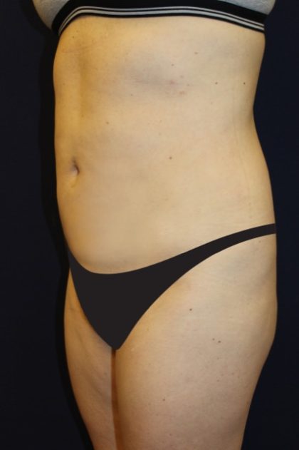 Tummy Tuck Before & After Patient #2885