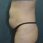 Tummy Tuck Before & After Patient #2885