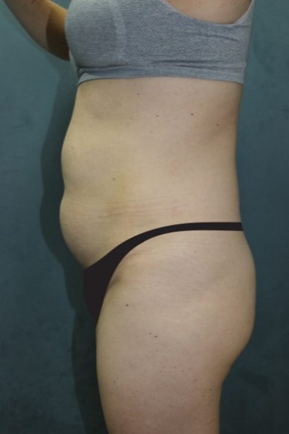 Tummy Tuck Before & After Patient #2885