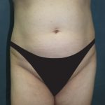 Tummy Tuck Before & After Patient #2885