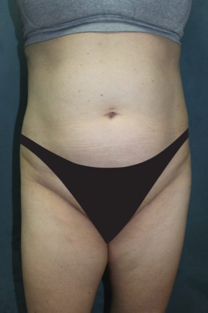 Tummy Tuck Before & After Patient #2885